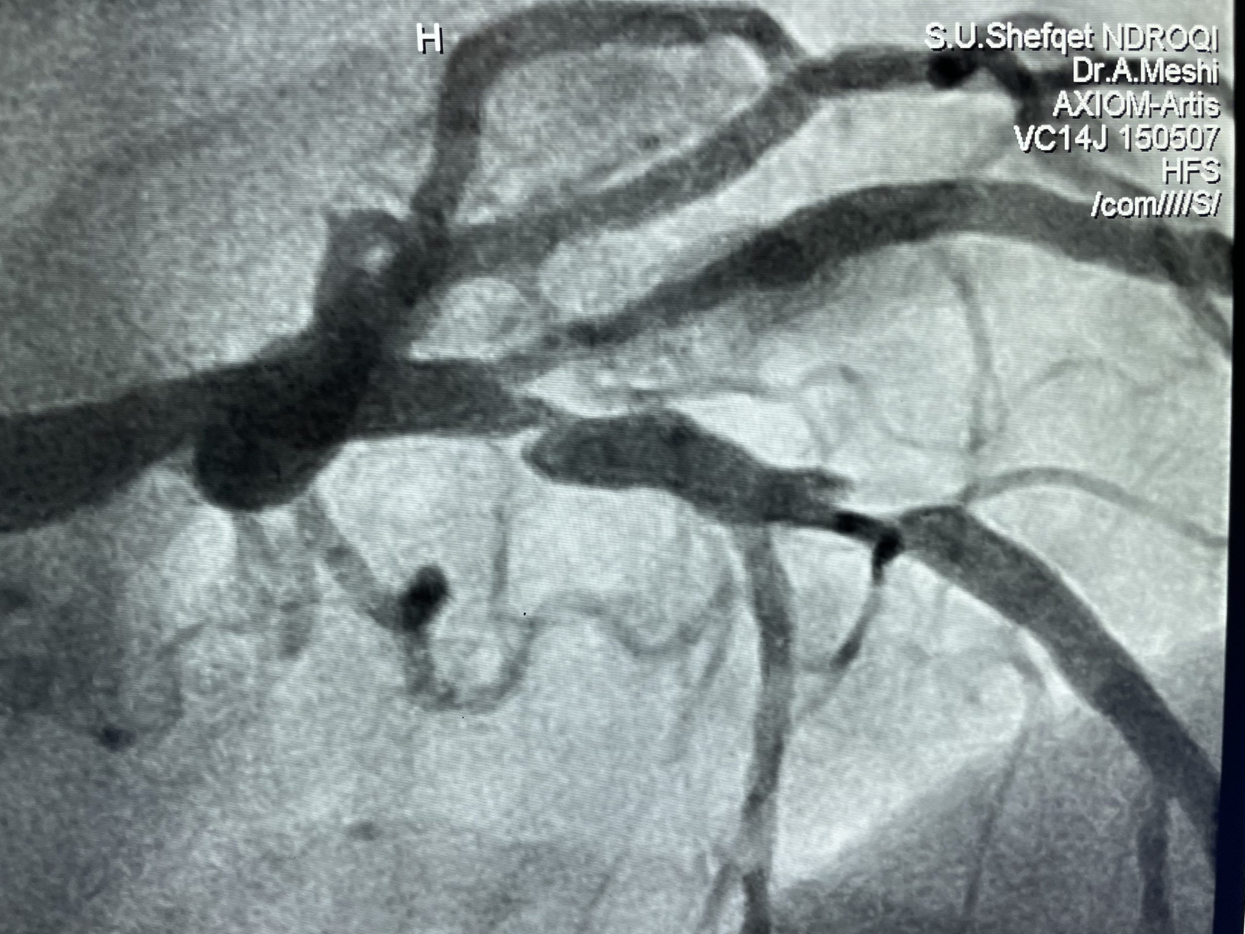 Coronary angiography