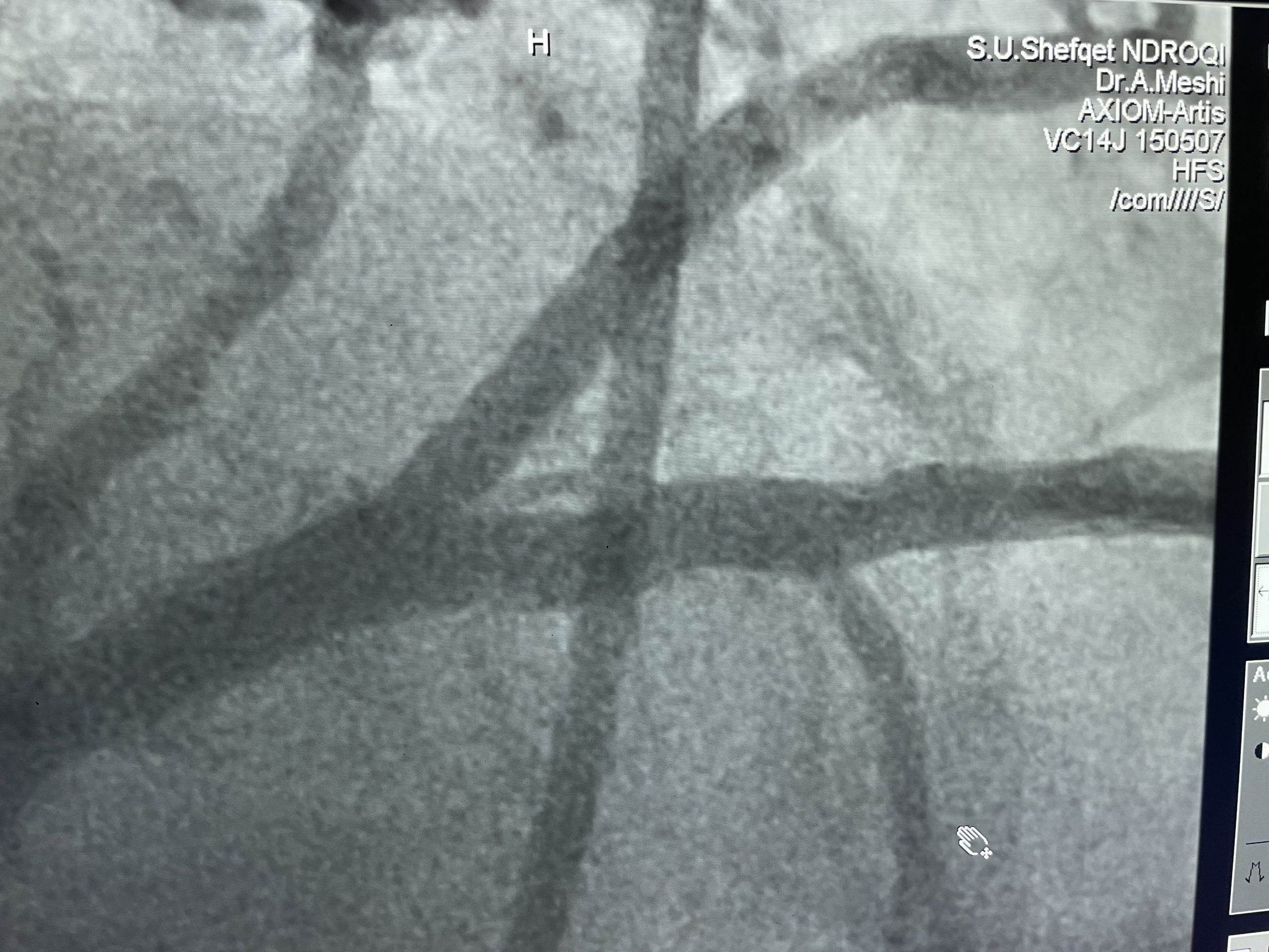 Cardiac stent angiogram